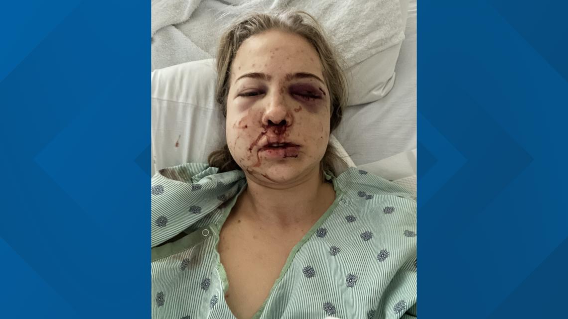 Cirque du Soleil Performer Seeks .75M in Lawsuit Following Devastating Fall and 11 Broken Bones