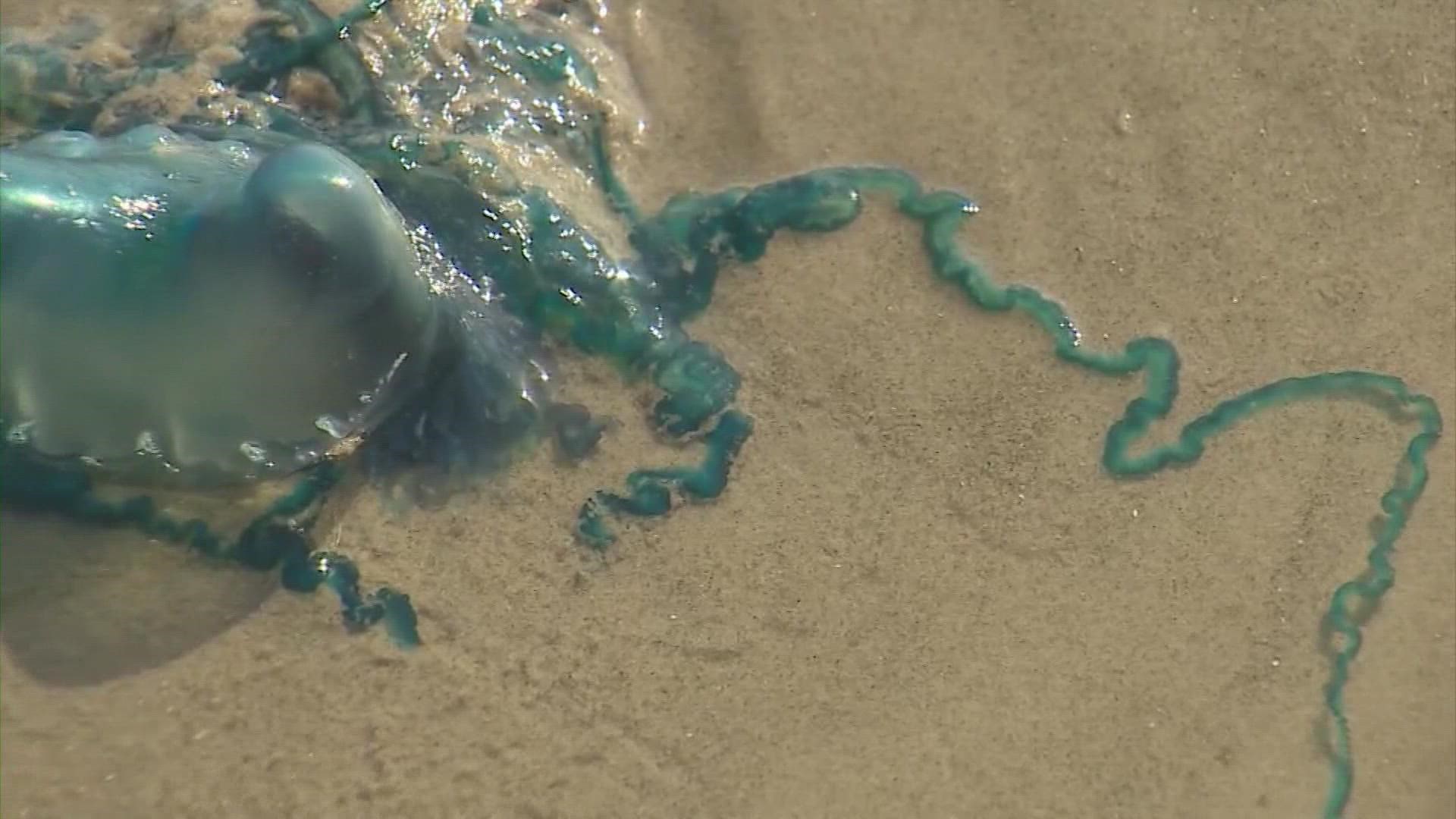 No, peeing on a jellyfish sting does not relieve the pain, and doctors warn against it.