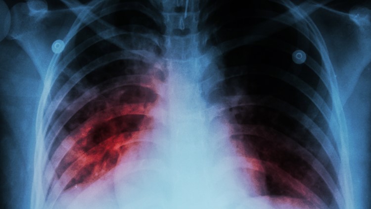Washington woman with tuberculosis detained after refusing treatment