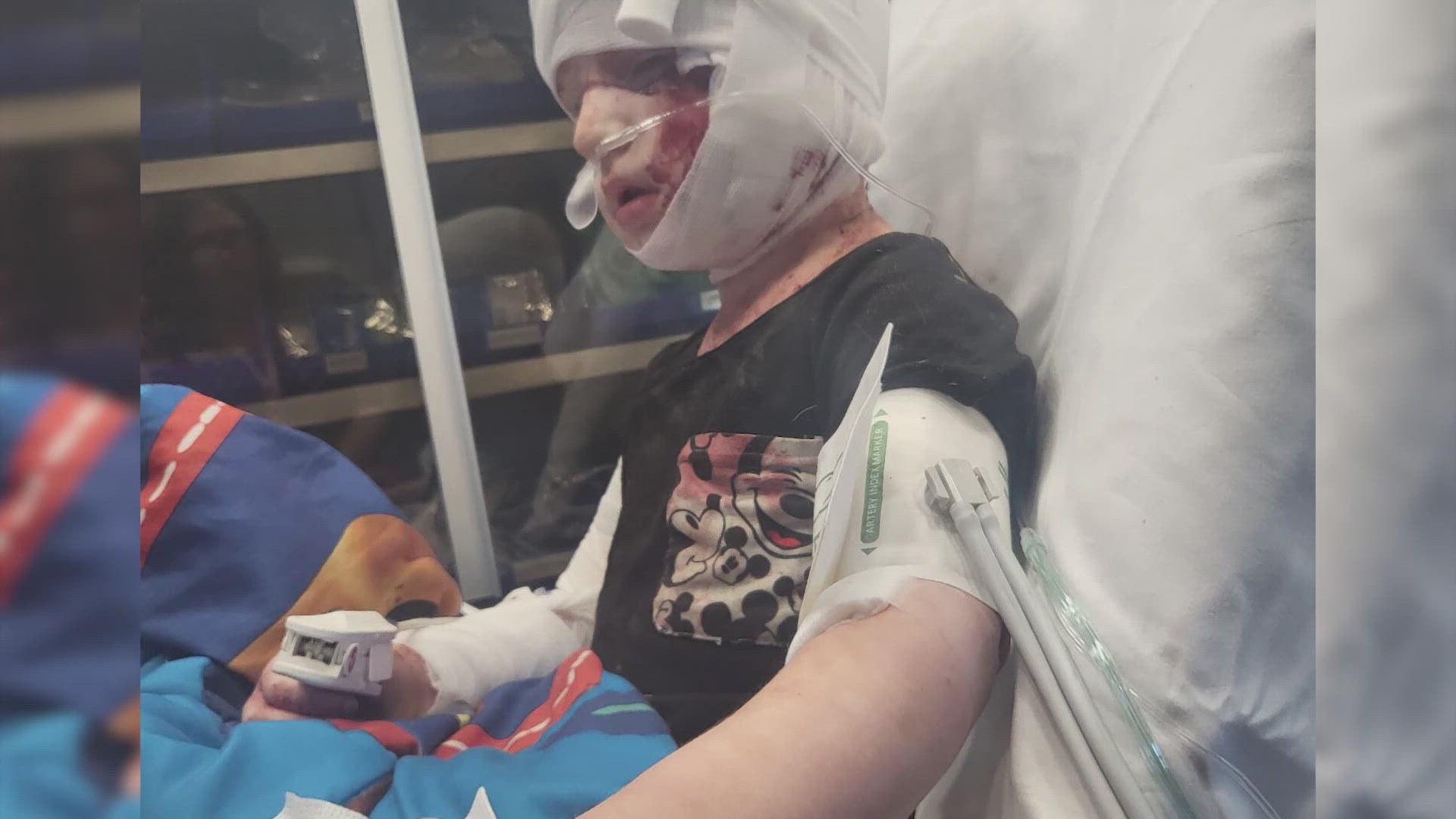 Tracy Moore says she shielded her 4-year-old from a savage dog attack, but they still ripped off his ear, forcing amputation after a week in the hospital.