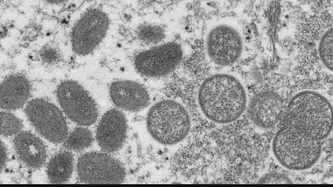 300+ cases of Monkeypox confirmed in US, CDC says