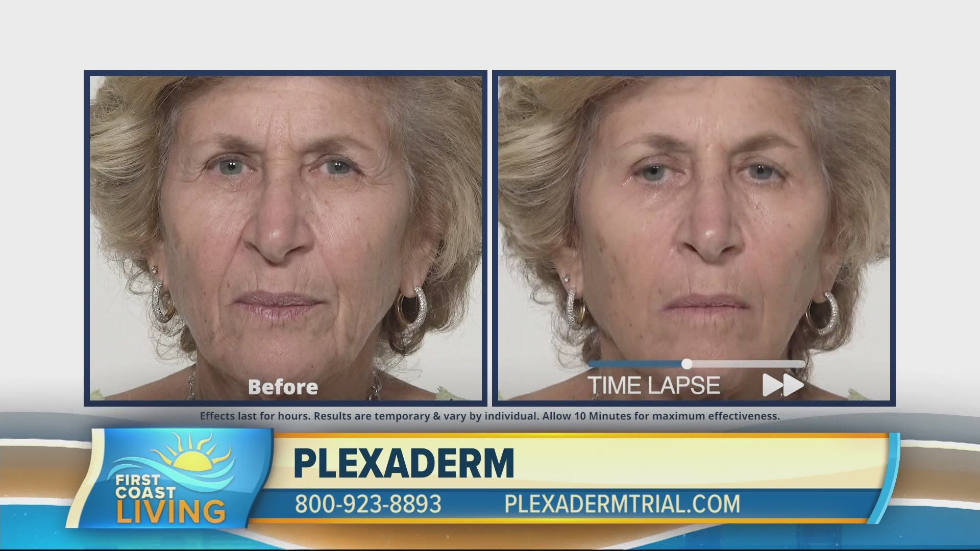 plexaderm forehead wrinkles