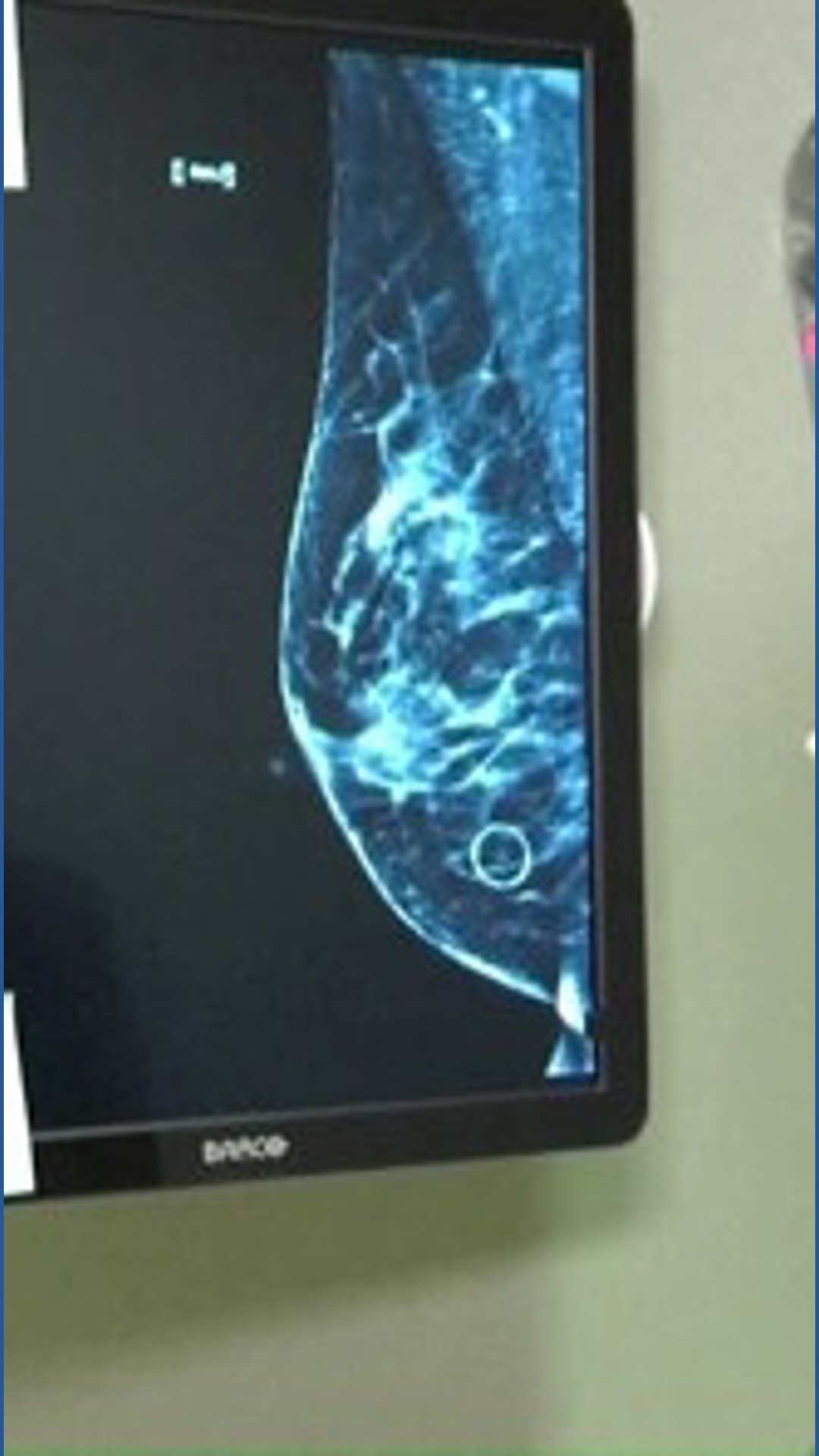 Minority women are more prone to aggressive breast cancer: Why early ...