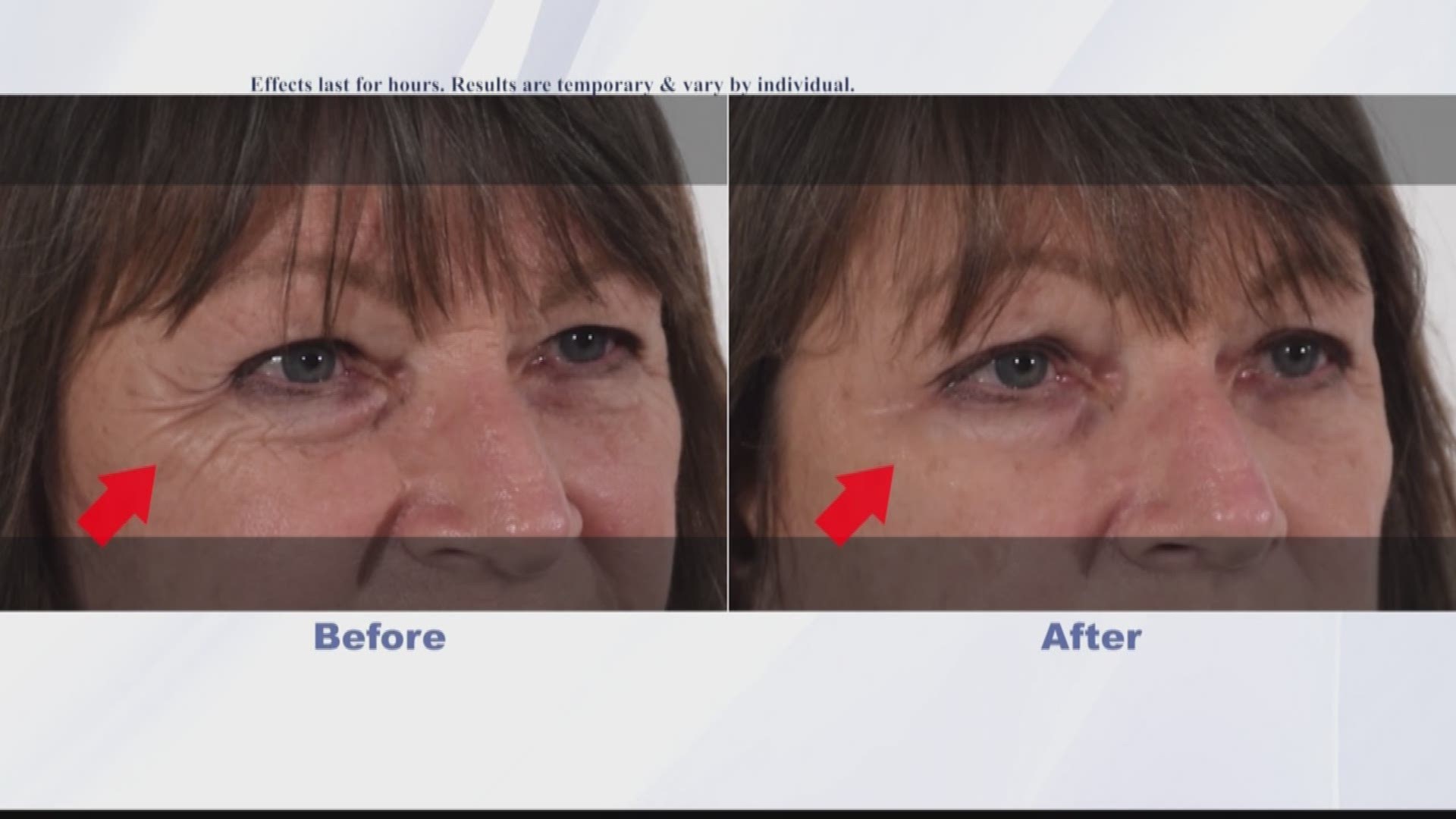 Bags under your eyes can be hard to get rid of, here's how Plexaderm can help!