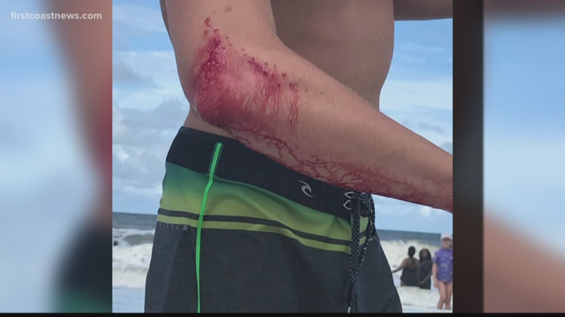 Jax Beach Surfer Not Afraid Of The Water After Shark Bite