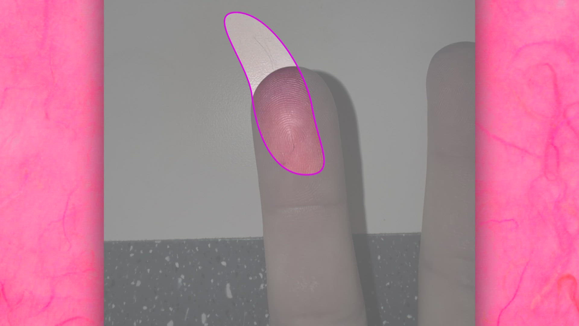 According to the National Cancer Institute, some 20% of breast cancer patients develop lymphedema.