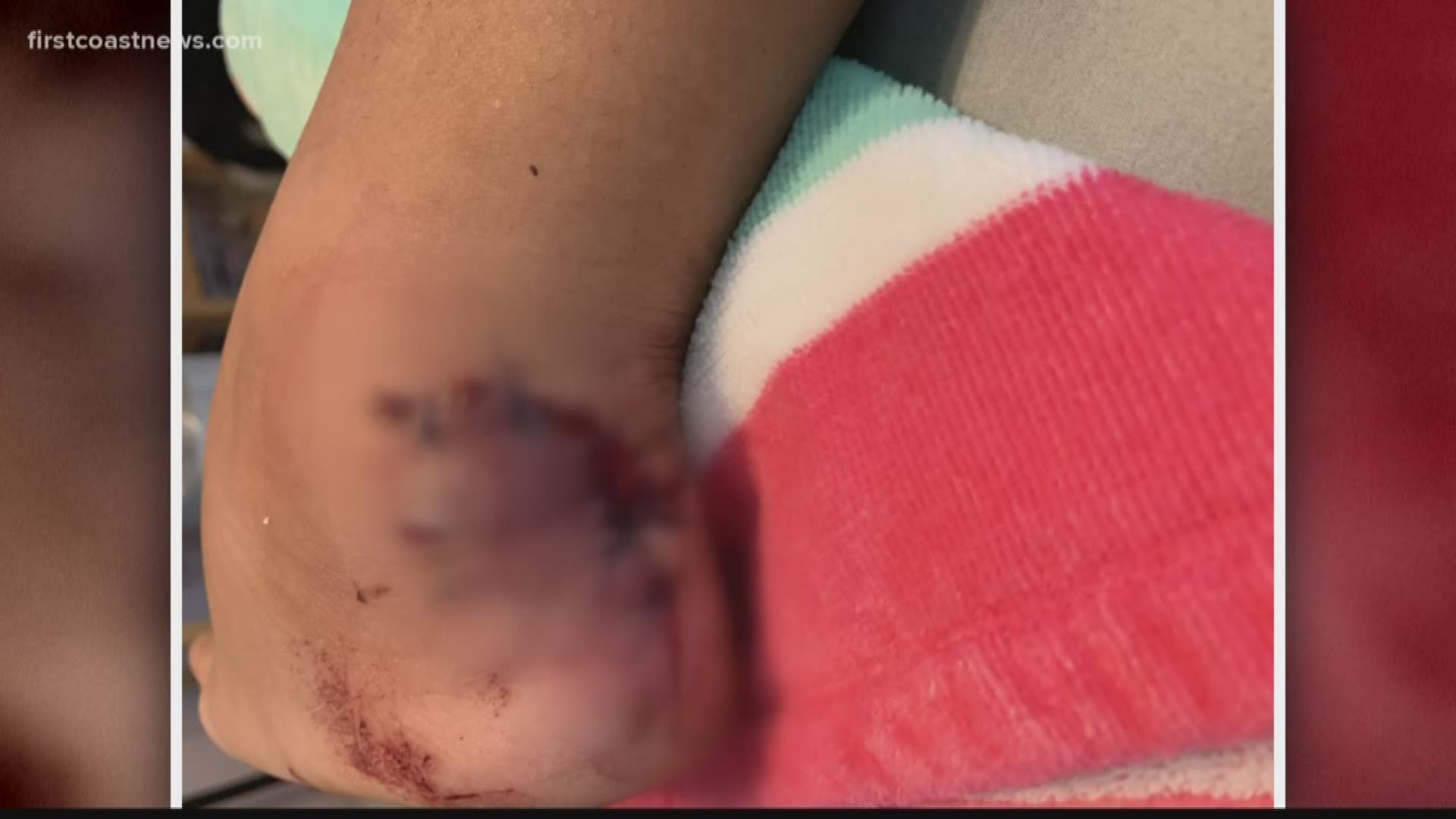 Around 7:30 a.m., the shark reportedly bit the teen while she was swimming near the Omni Amelia Island Plantation Resort.