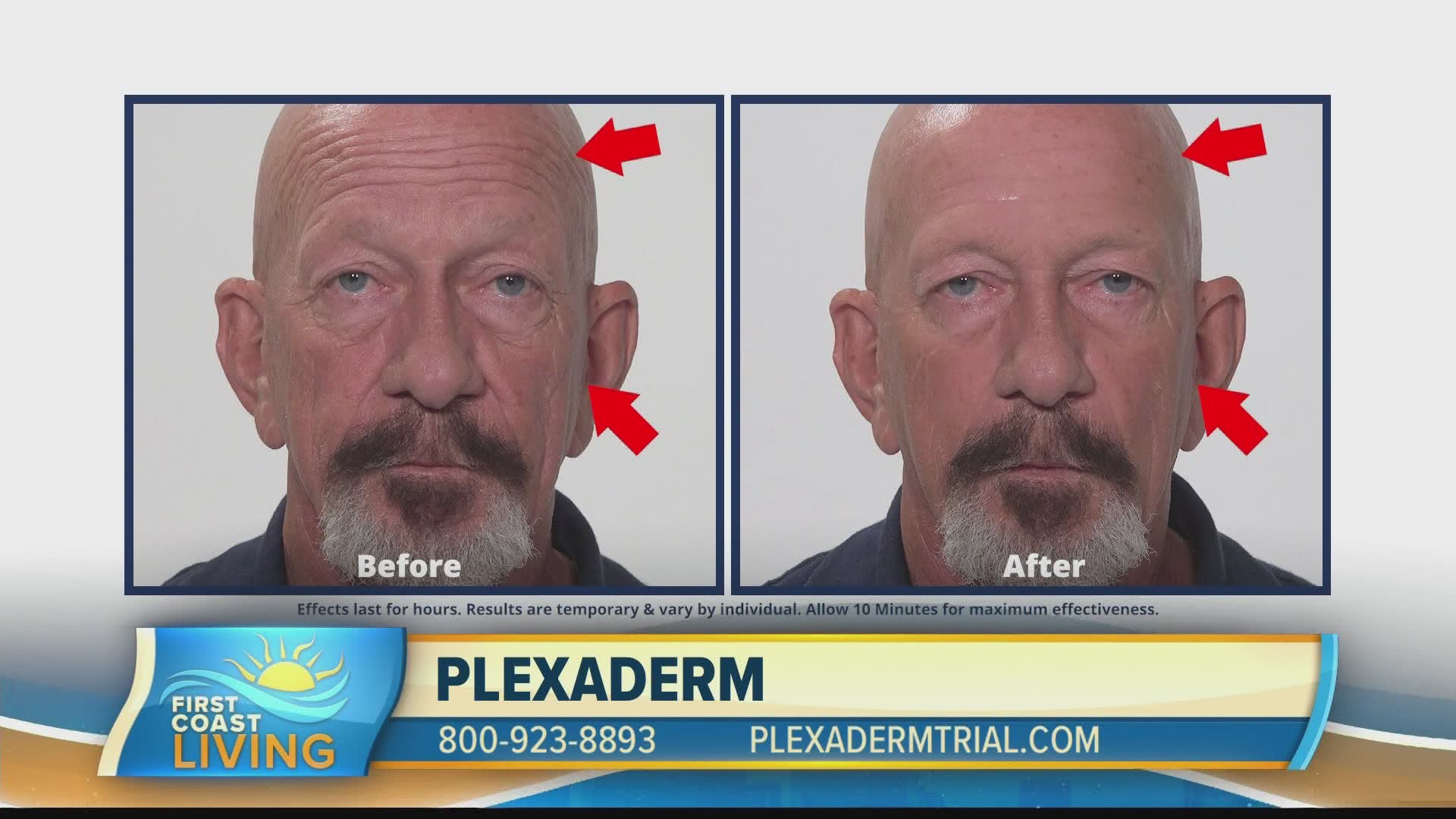 Plexaderm can help eliminate those key signs of aging.