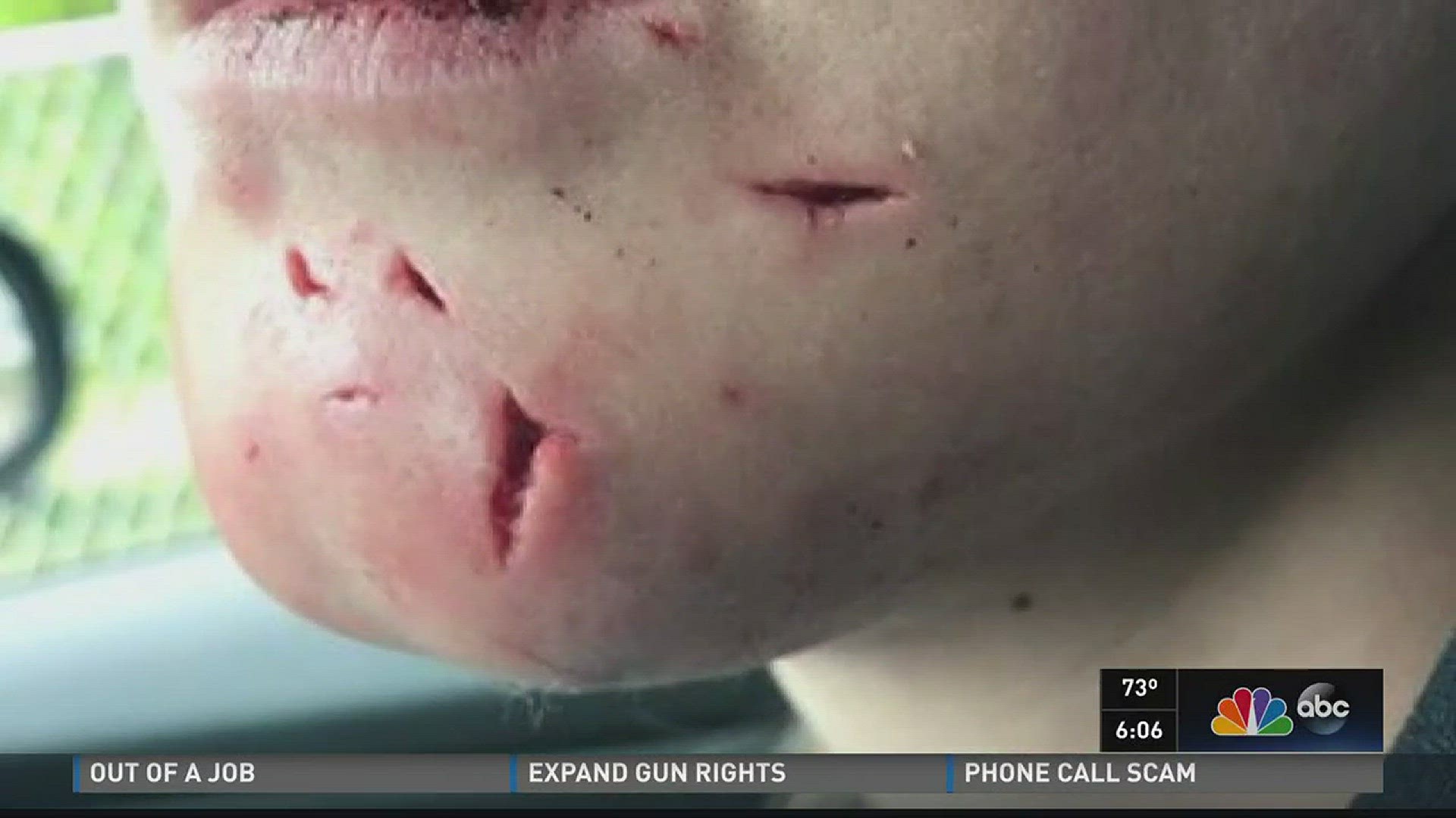 Woman recovering from severe dog attack