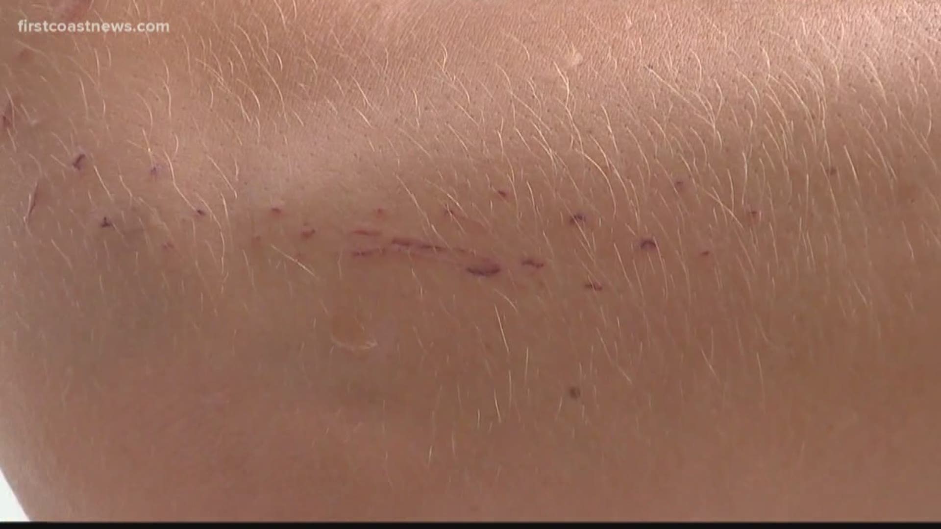 A professional surfer says he's lucky to still have his arm after he was bitten by a shark near the Jacksonville Beach Pier on Saturday.