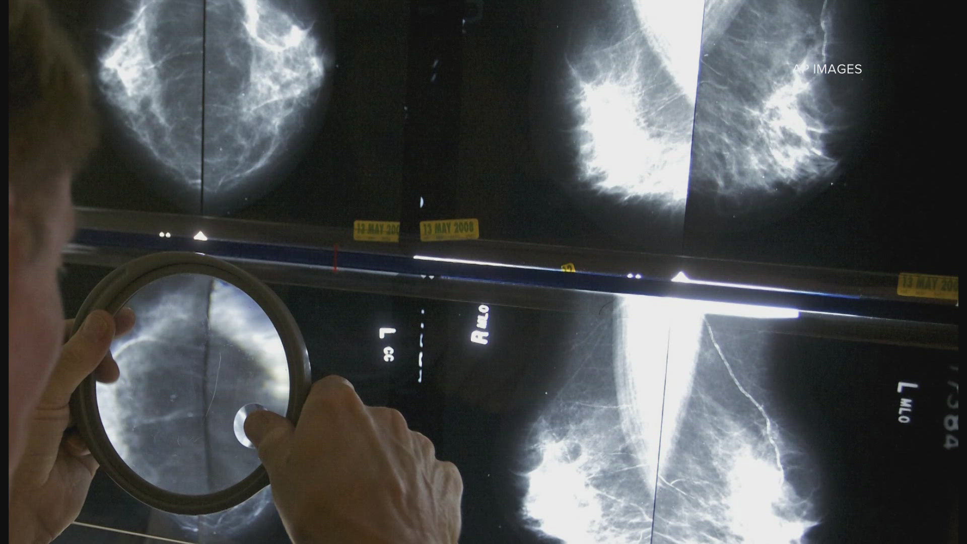 Experts recommend mammograms starting at the age of 40, once a year.
