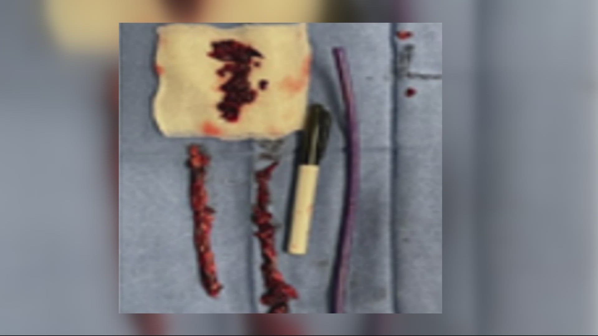 Doctors at HCA Florida Memorial hospital pulled out blood clots from a man's lung that were eight to nine inches long.