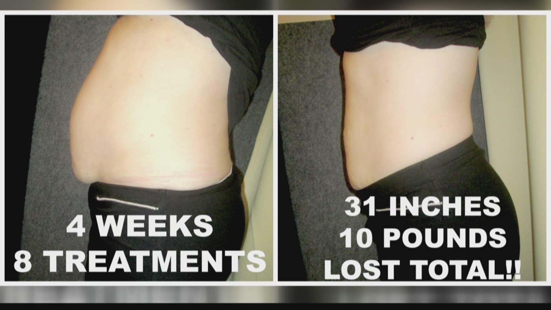 i-Lipo is a non-invasive procedures that can help you shed unwanted pounds.