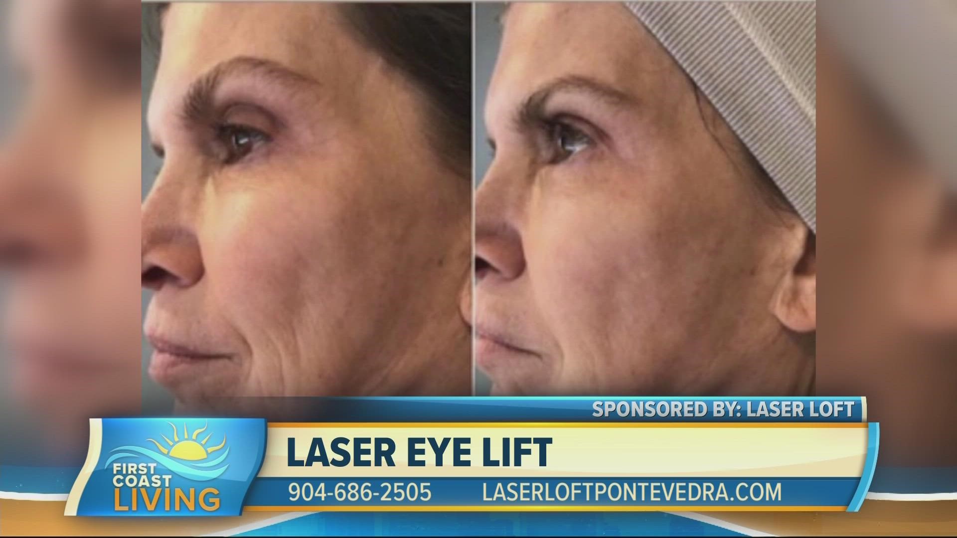 Laser Loft offers a procedure that targets the various signs of aging around our eyes.