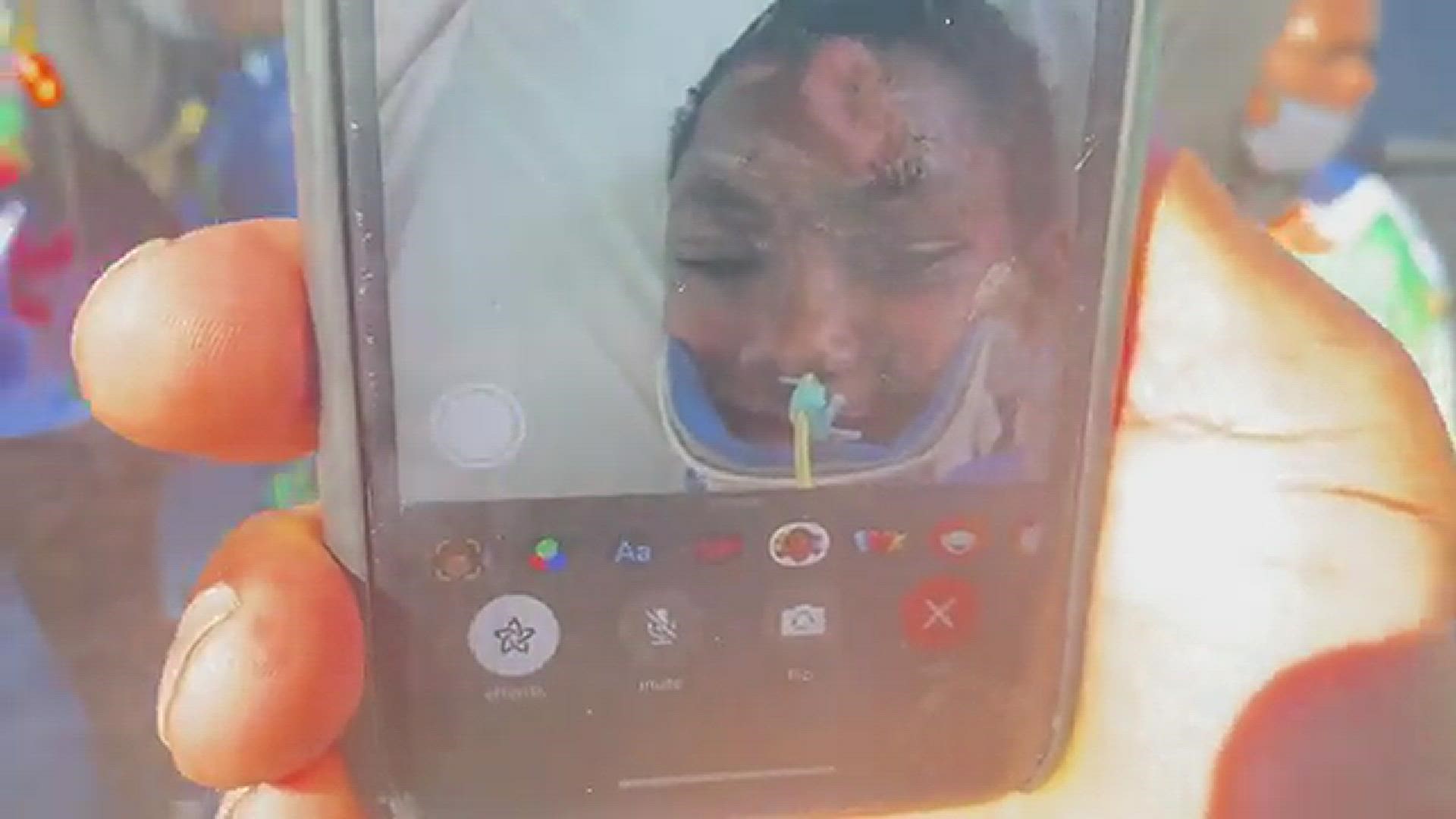 Vito Johnson, 11, is on the mend after his skull was fractured in a hit-and-run on Feb. 4. He was in a coma and on a ventilator. JSO has released no information.