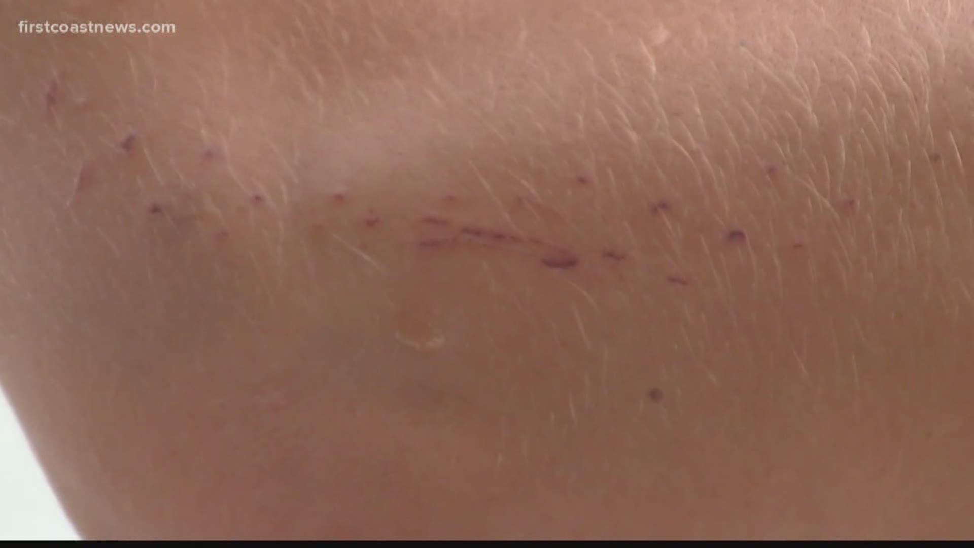 Surfer Attacked By Shark In Jacksonville Firstcoastnews Com