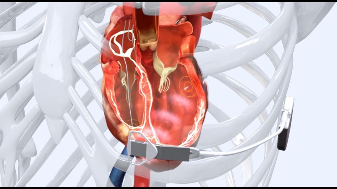 Doctors warn about new smart phone's risk with pacemakers