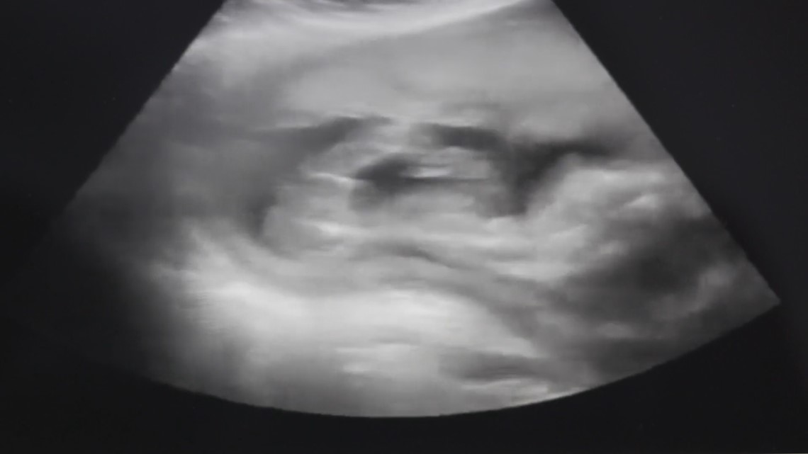 How far into a pregnancy can a person get an abortion in Florida? - Vimarsana News