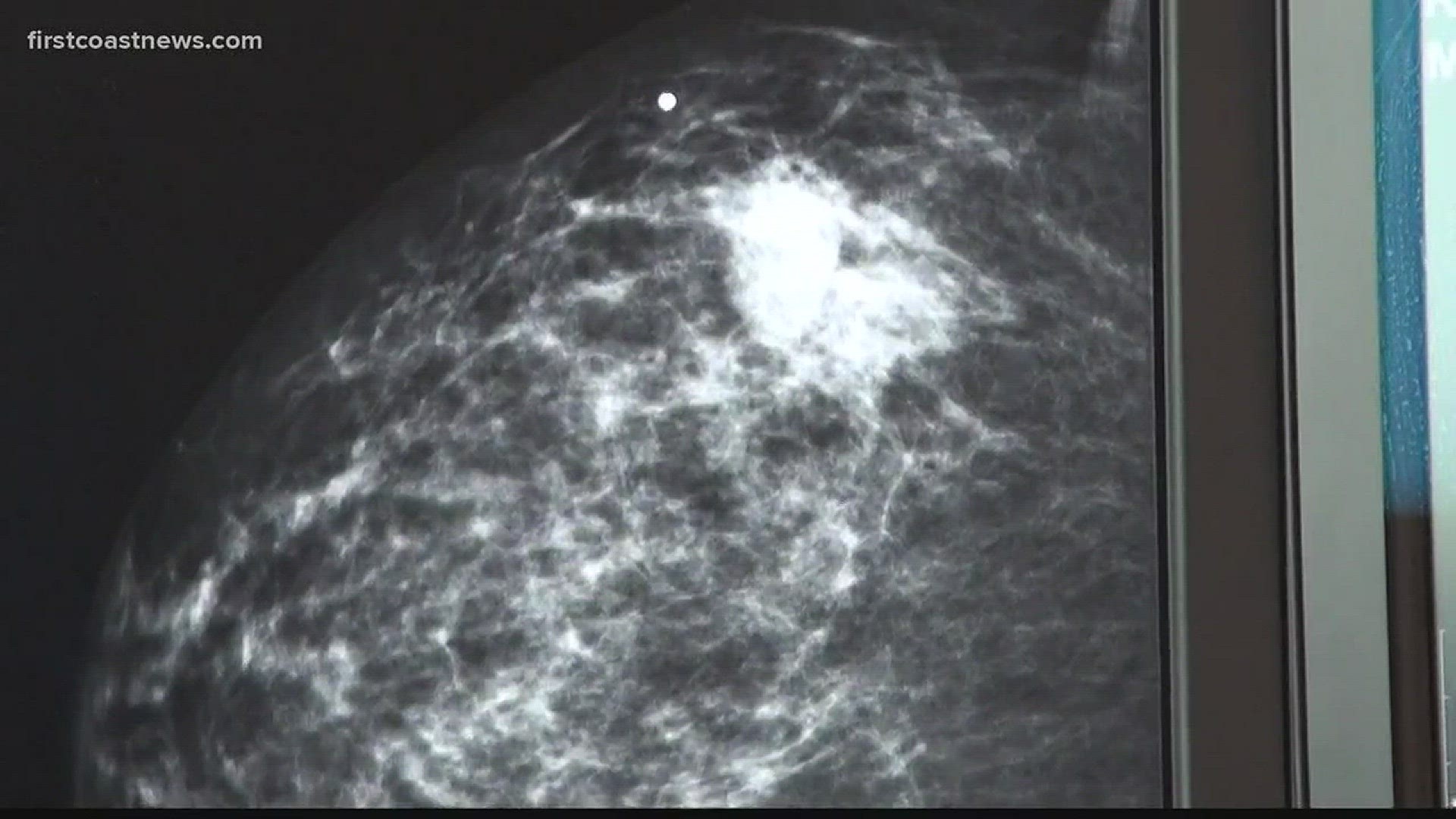 Ezorine found triple negative breast cancer before it invaded her lymph nodes.