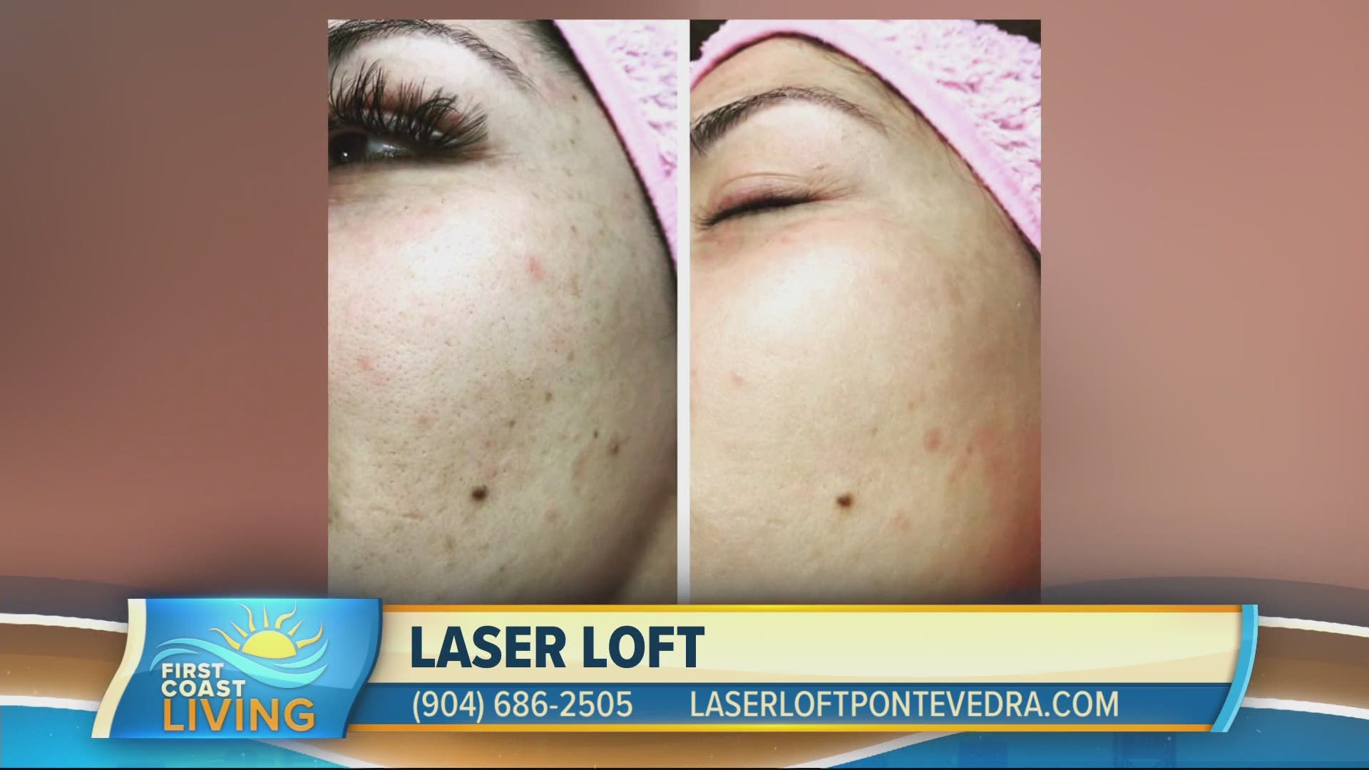 Try this quick non-invasive treatment to breathe life back into your skin at Laser Loft!
