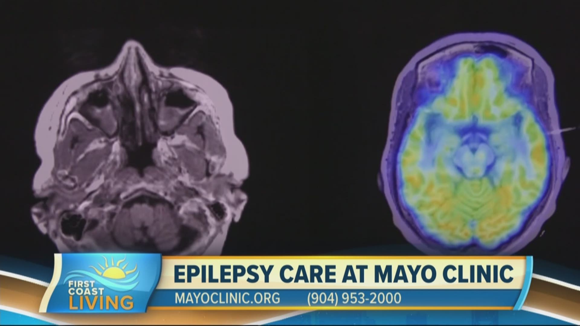 Learn More About Epilepsy New Treatment Options At Mayo Clinic Fcl October 2nd 8854