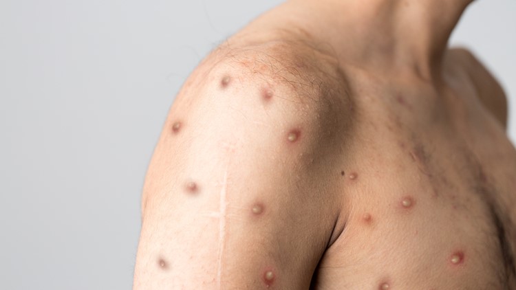 What you need to know about monkeypox in Florida